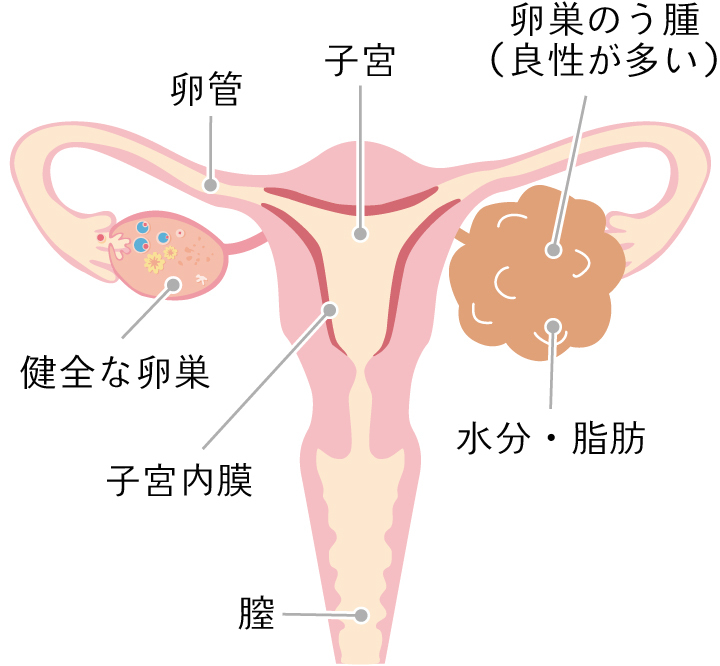 卵巣腫瘍とは？