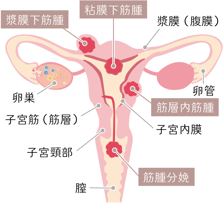 子宮筋腫