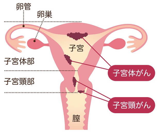 子宮体がんとは？罹患しやすい年齢は？