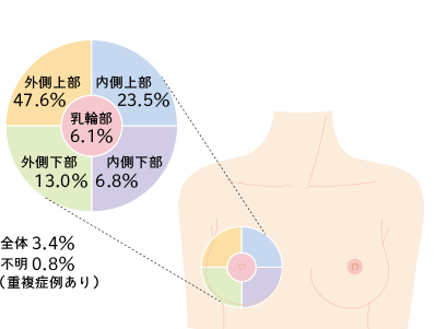 乳がんができやすい箇所