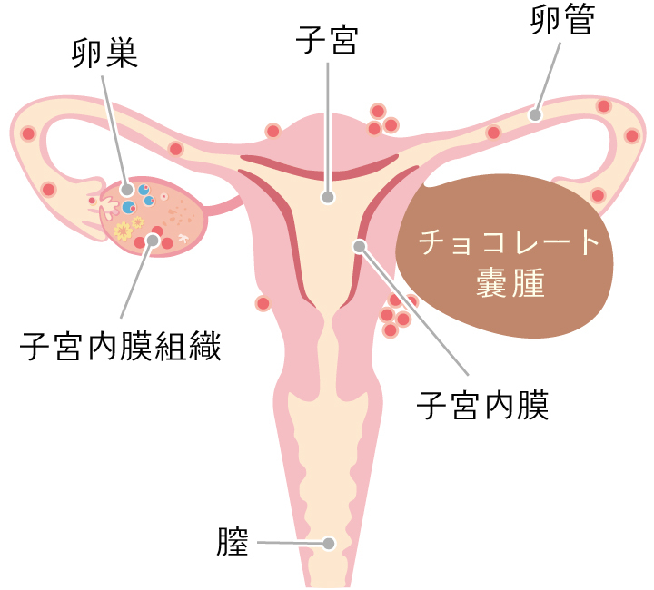 子宮内膜症