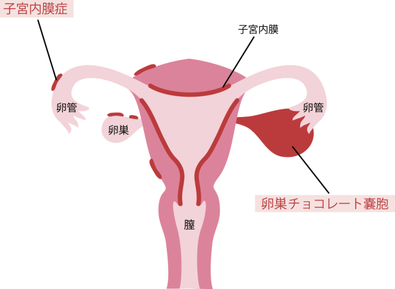 子宮筋腫と子宮内膜症の違い - Genspark