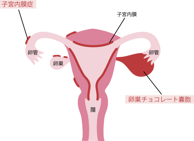 子宮内膜症の症状や原因・治し方は？｜京都の足立病院